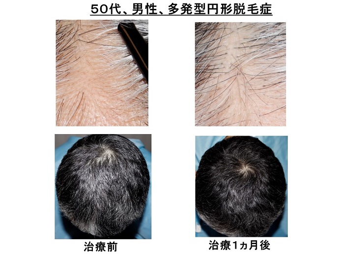 円形脱毛症　病院